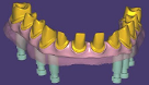 Bridge sur implant "Thimble Crown" (couronne en forme de dé à coudre)