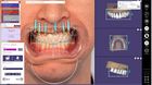"Thimble Crown" Implantatbrücke mit Smile Design