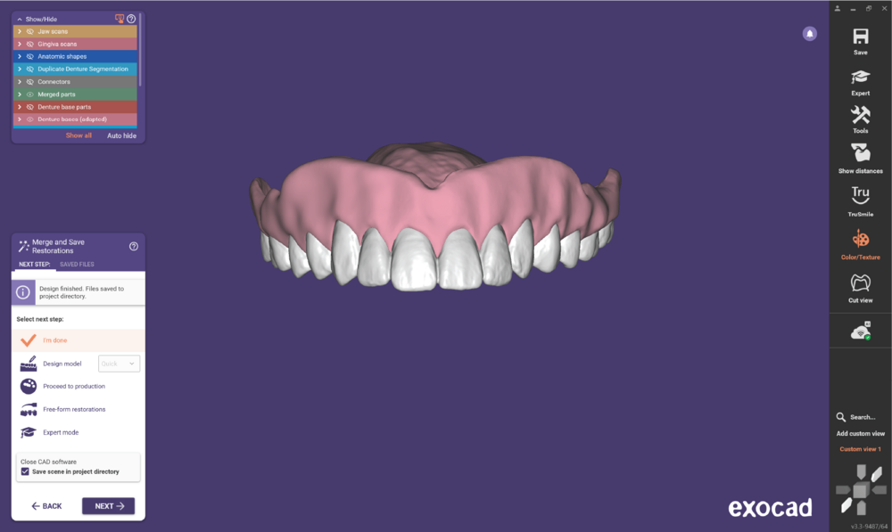 Duplicate denture3.3-14.png