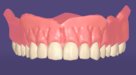 SingleArchDenture.png