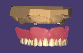 RP5 prosthesis