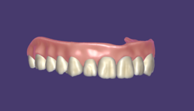 FP3 prosthesis