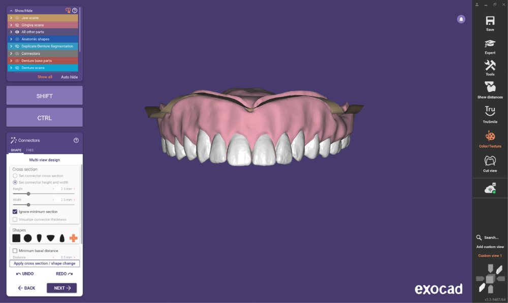 Duplicate denture3.3-11.png