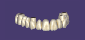 FP2 prosthesis
