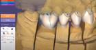 Morphing anatomique instantané dans DentalCAD Galway