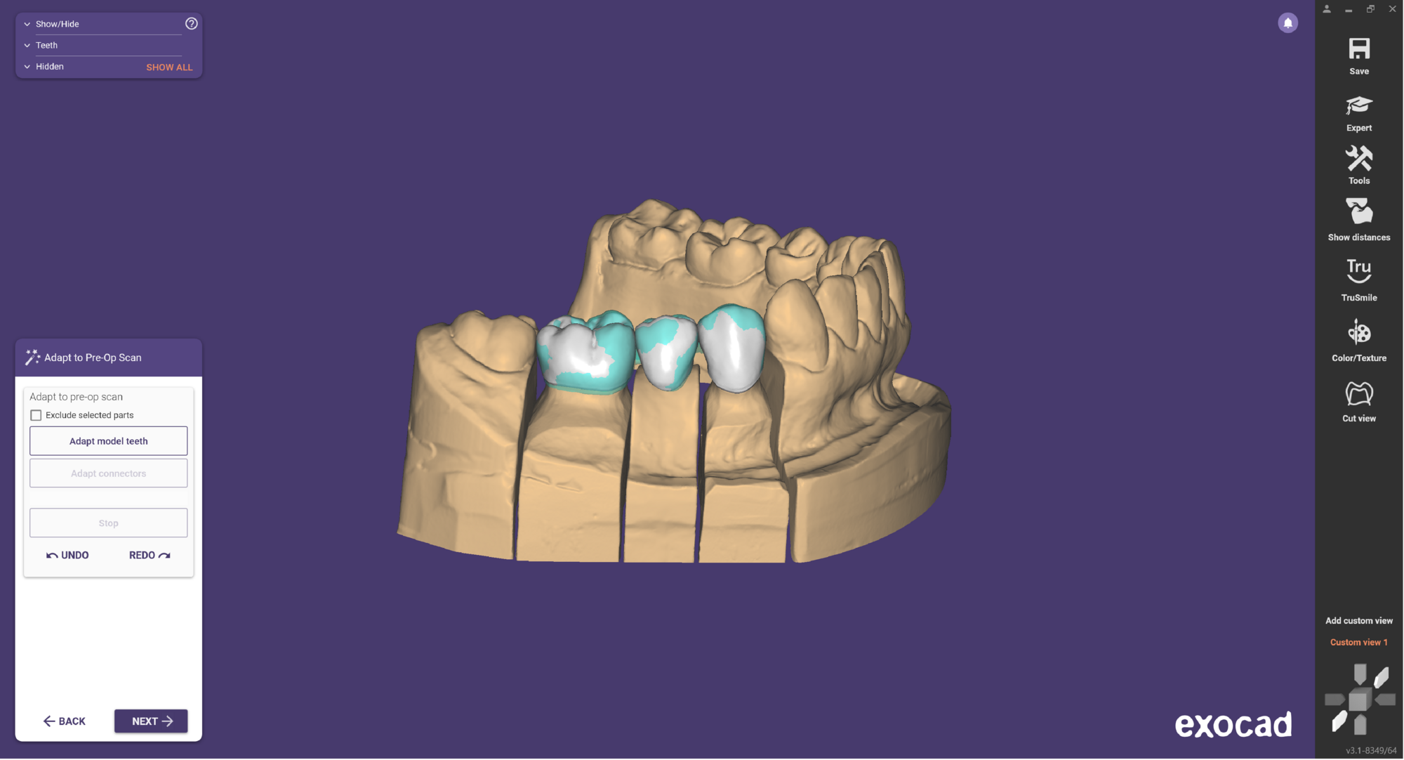 Understanding the difference between Pre-op and Waxup feature - exocad