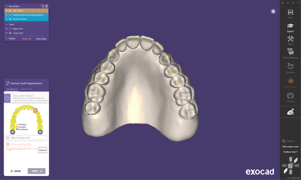 Duplicate denture3.3-06.png