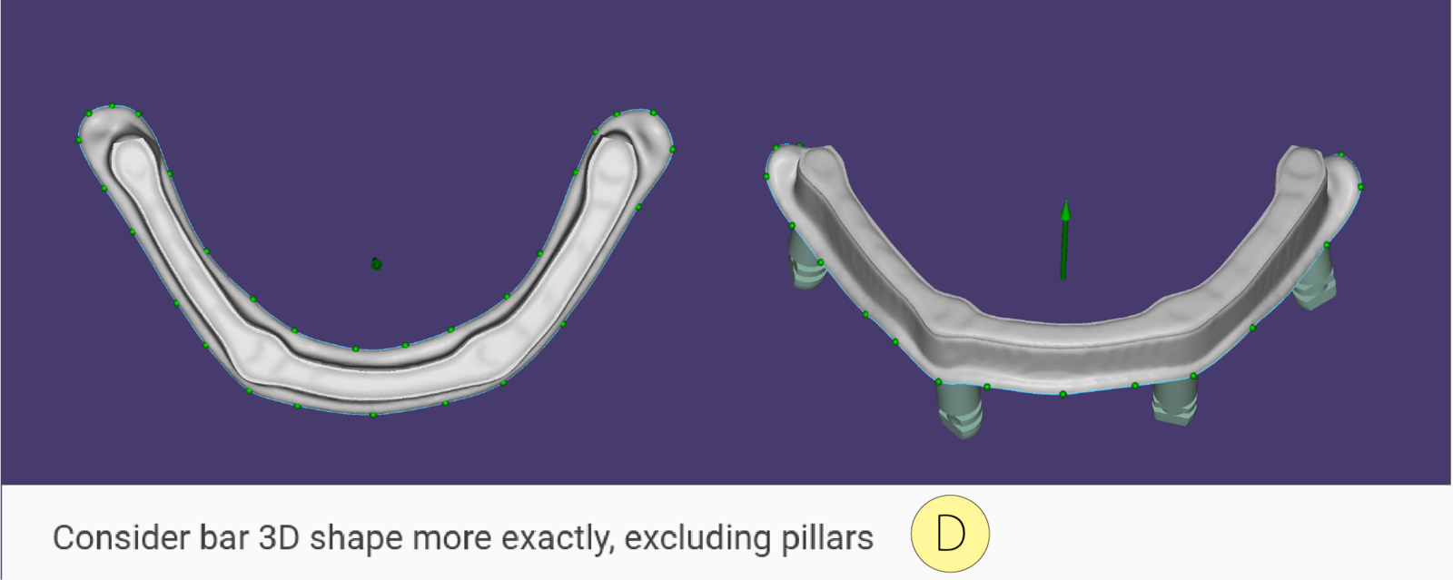 Bar Module Split Bar - exocad