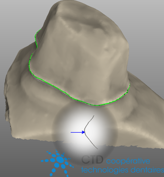 D Tecter Modifier Les Limites Exocad