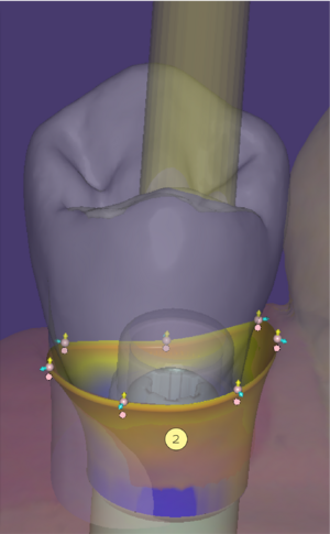 Generate abutment bottoms 1 3.2.png