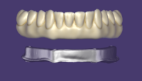 Hybrid dentures-03.png