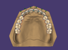 Adjusting Denture tooth placement
