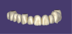 FP1 prosthesis