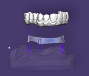 Split bar partial-0.png