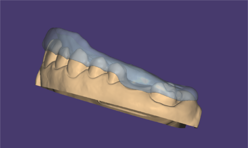 Design Bite splint missing tooth example.PNG