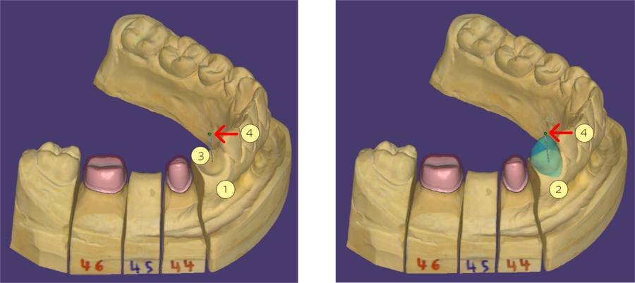 Extract tooth Select 1.png