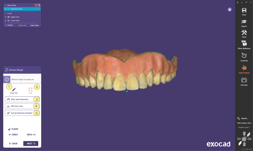 Duplicate denture3.3-05.png