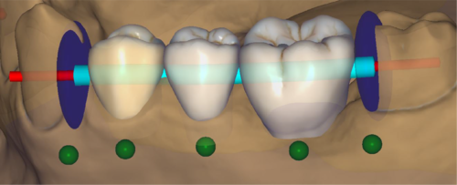 ToothPlacement chain tube.png